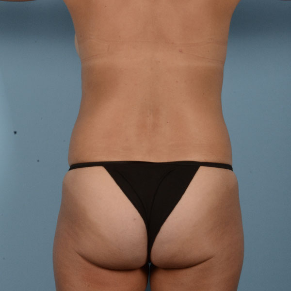 Tummy Tuck (Abdominoplasty)  Before & After Gallery - Patient 121839632 - Image 7
