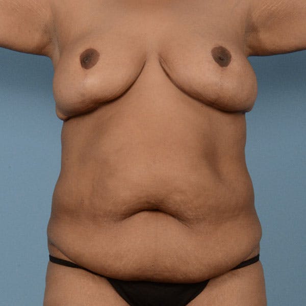 Tummy Tuck (Abdominoplasty)  Before & After Gallery - Patient 121839633 - Image 1