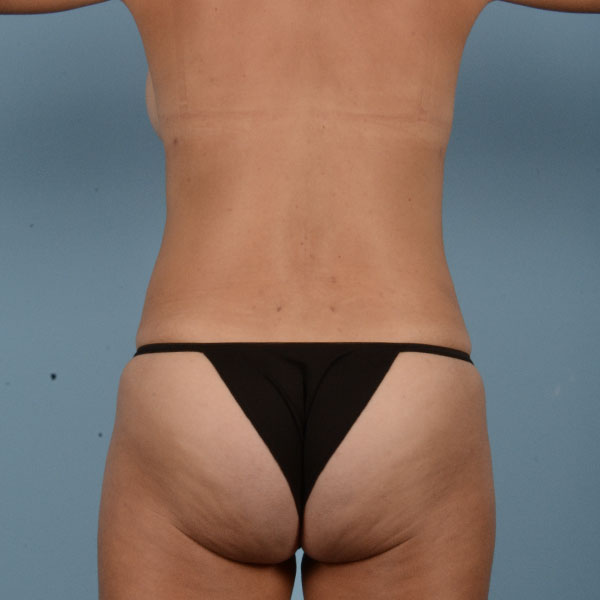 Liposuction Before & After Gallery - Patient 121839518 - Image 8