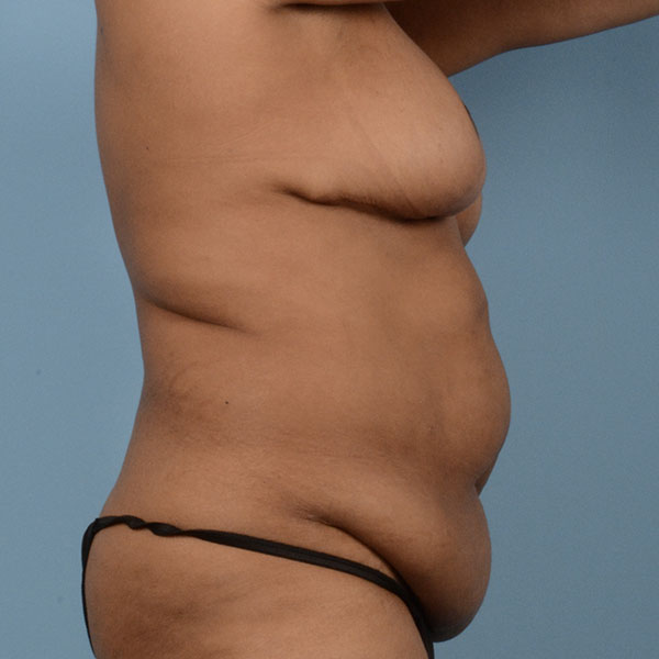 Tummy Tuck (Abdominoplasty)  Before & After Gallery - Patient 121839633 - Image 3