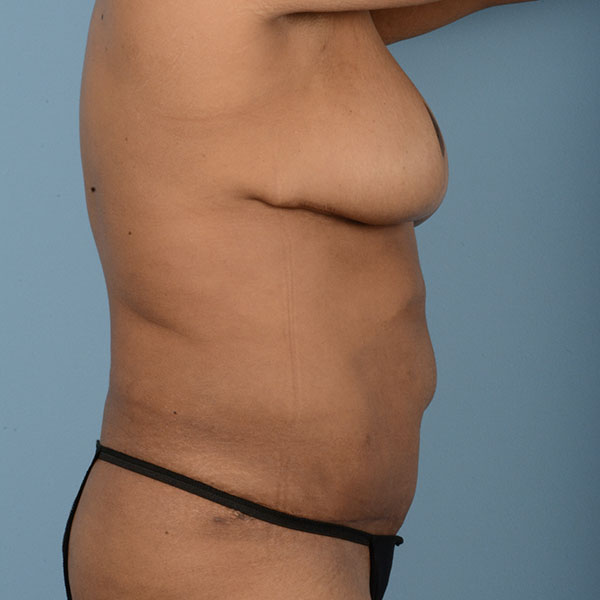 Tummy Tuck (Abdominoplasty)  Before & After Gallery - Patient 121839633 - Image 4