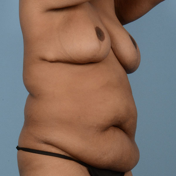 Liposuction Before & After Gallery - Patient 121839519 - Image 5