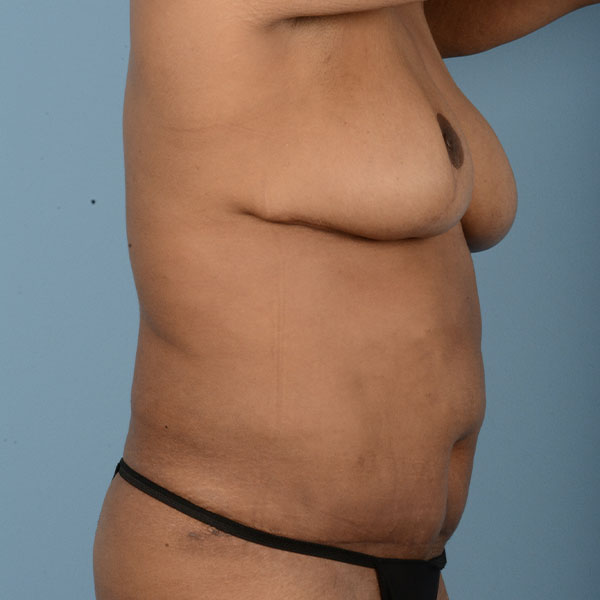 Tummy Tuck (Abdominoplasty)  Before & After Gallery - Patient 121839633 - Image 6