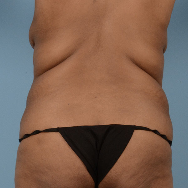 Tummy Tuck (Abdominoplasty)  Before & After Gallery - Patient 121839633 - Image 7