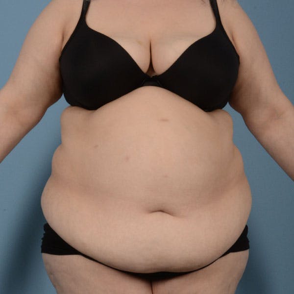 Tummy Tuck (Abdominoplasty)  Before & After Gallery - Patient 121839634 - Image 1