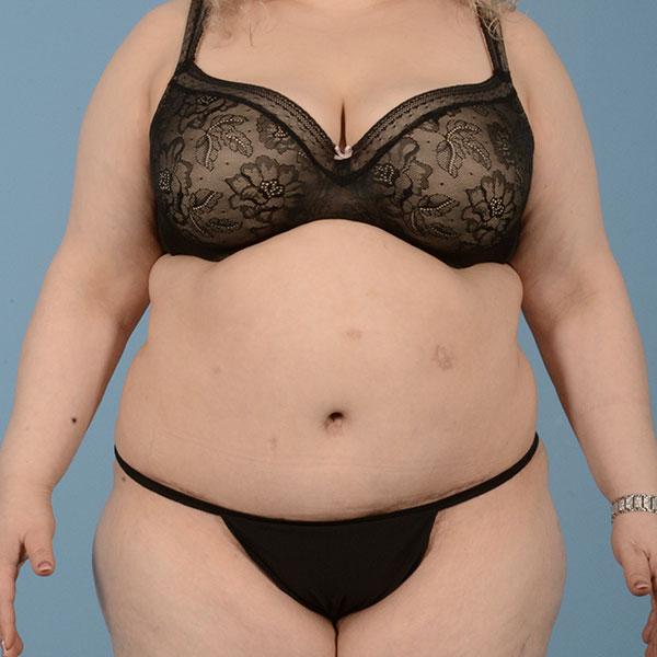 Tummy Tuck (Abdominoplasty)  Before & After Gallery - Patient 121839634 - Image 2