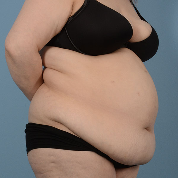 Tummy Tuck (Abdominoplasty)  Before & After Gallery - Patient 121839634 - Image 3