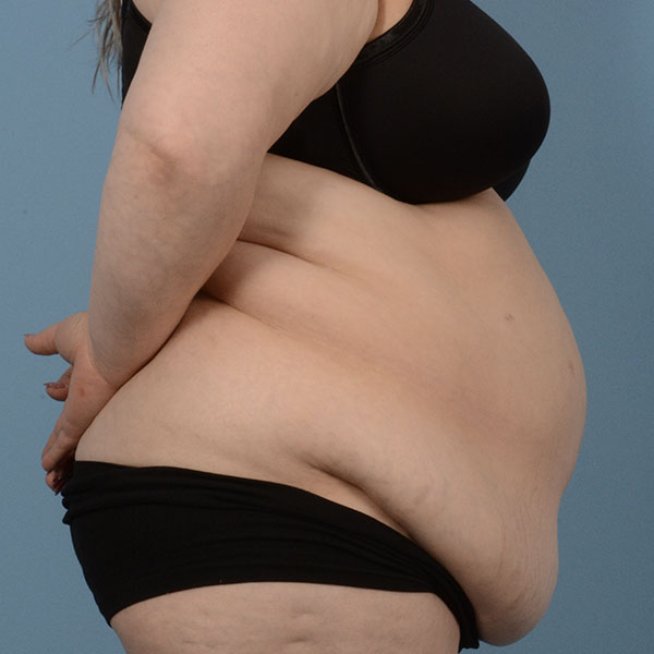Tummy Tuck (Abdominoplasty)  Before & After Gallery - Patient 121839634 - Image 5