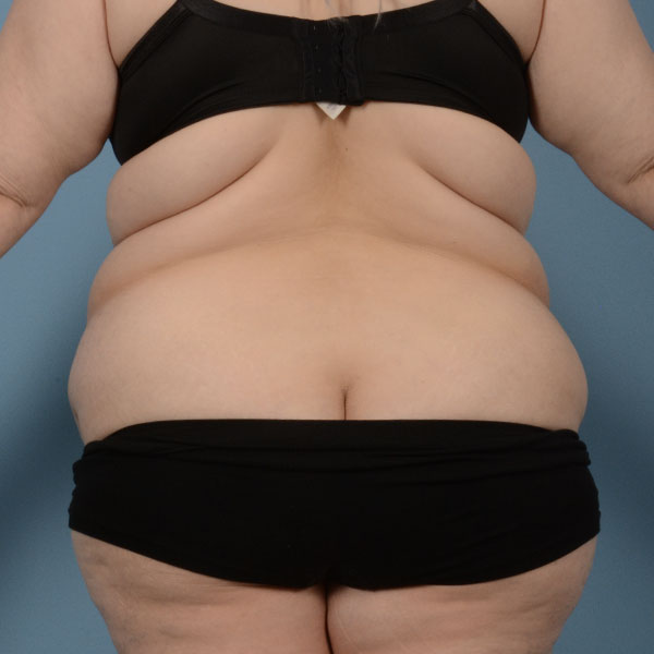 Tummy Tuck Before & After Gallery - Patient 121839634 - Image 7