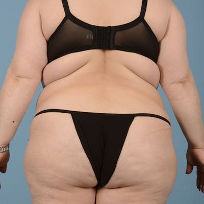 Tummy Tuck (Abdominoplasty)  Before & After Gallery - Patient 121839634 - Image 8
