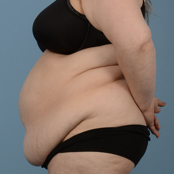 Tummy Tuck (Abdominoplasty)  Before & After Gallery - Patient 121839634 - Image 9