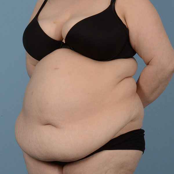 Liposuction Before & After Gallery - Patient 121839520 - Image 11