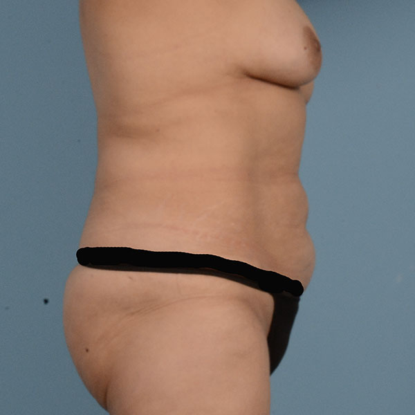 Tummy Tuck (Abdominoplasty)  Before & After Gallery - Patient 121839635 - Image 5