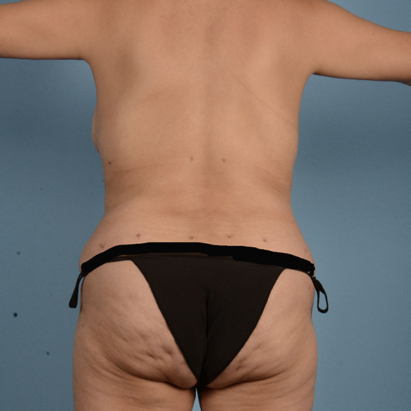 Liposuction Before & After Gallery - Patient 121839521 - Image 10