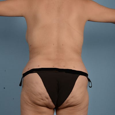 Tummy Tuck (Abdominoplasty)  Before & After Gallery - Patient 121839635 - Image 10