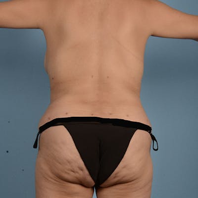 Tummy Tuck Before & After Gallery - Patient 121839635 - Image 10