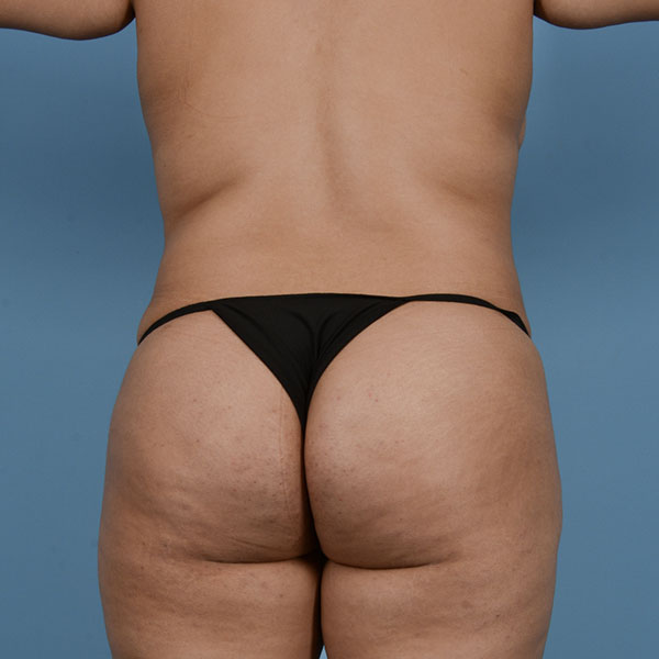 Liposuction Before & After Gallery - Patient 121839522 - Image 12