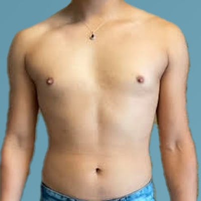 Liposuction Before & After Gallery - Patient 122428150 - Image 1