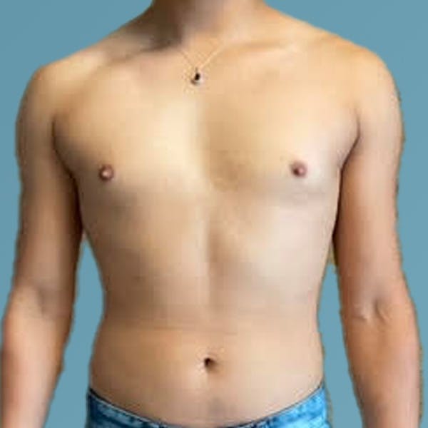 Liposuction Before & After Gallery - Patient 122428150 - Image 1