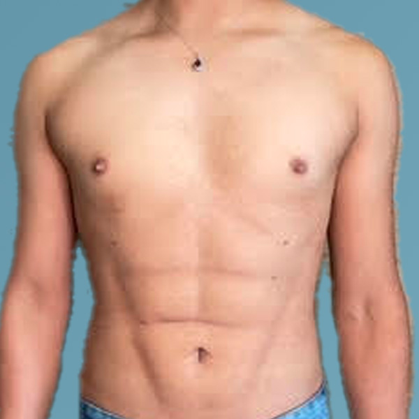 Liposuction Before & After Gallery - Patient 122428150 - Image 2
