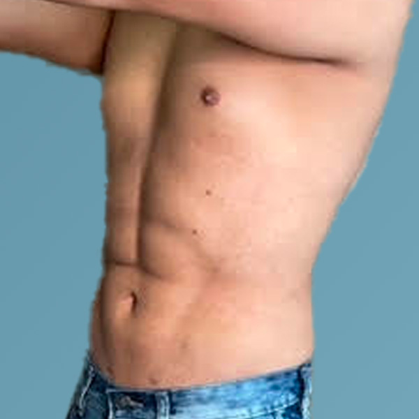 Liposuction Before & After Gallery - Patient 122428150 - Image 4