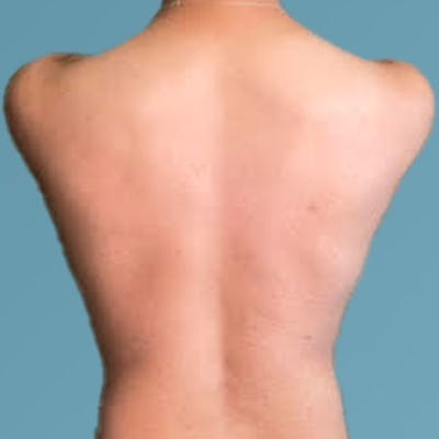 Liposuction Before & After Gallery - Patient 122428150 - Image 10