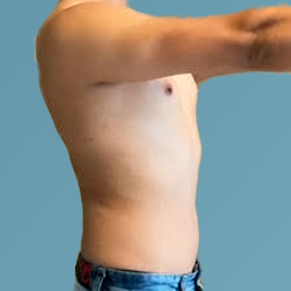 Liposuction Before & After Gallery - Patient 122428150 - Image 13