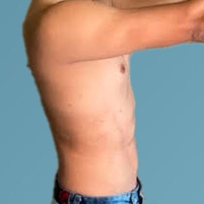 Liposuction Before & After Gallery - Patient 122428150 - Image 14