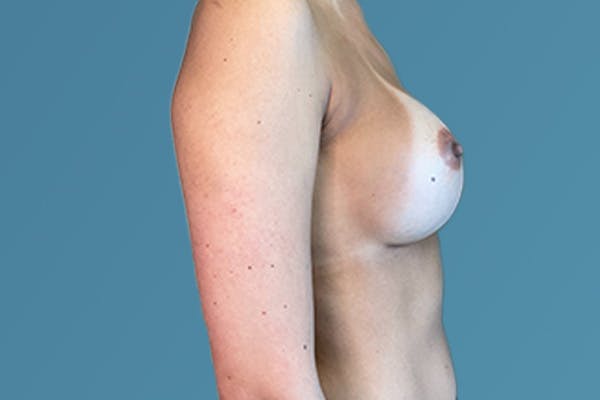 Breast Revision Before & After Gallery - Patient 122610791 - Image 2