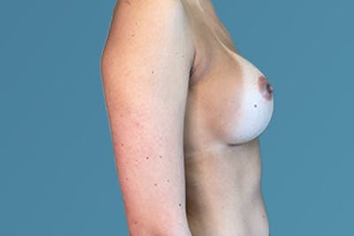 Breast Revision Gallery - Patient 122610791 - Image 2