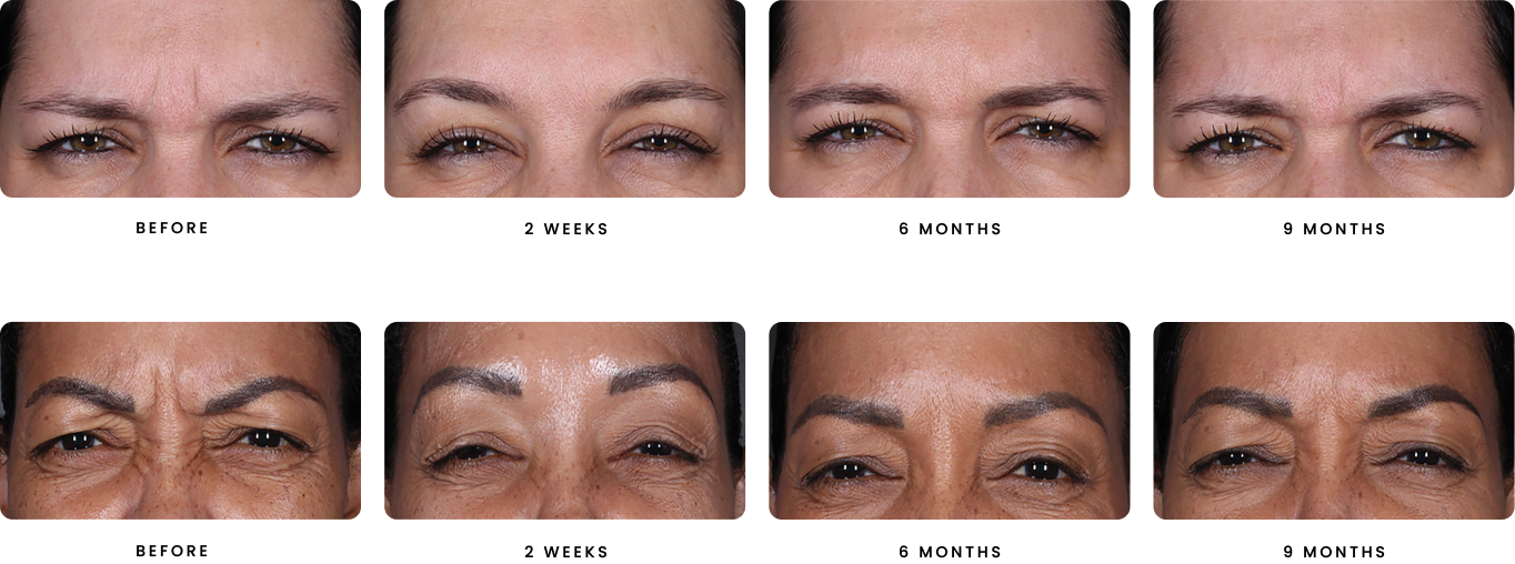 before and afters of patients after having Daxxify treatments