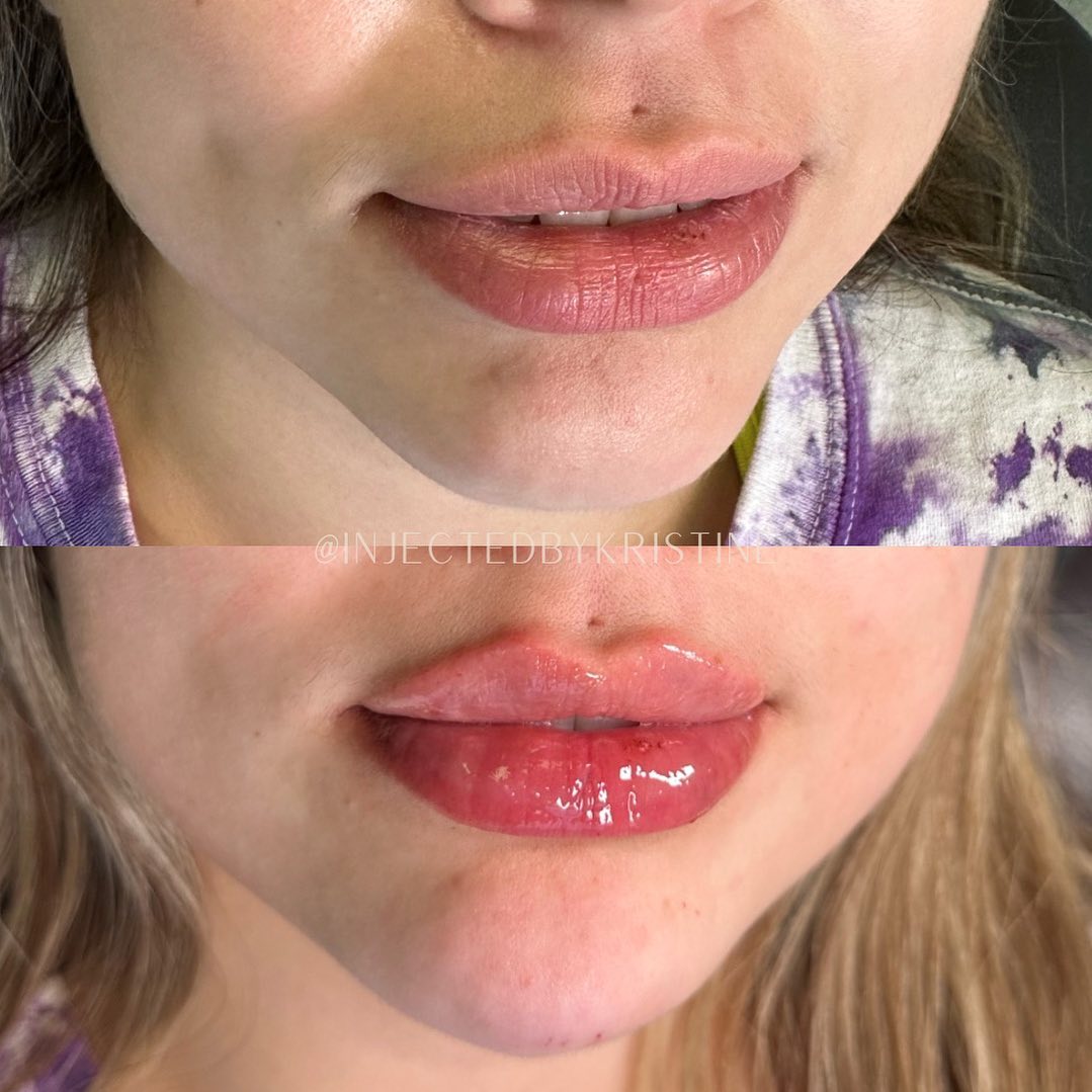 before and after front view of a patient's lips after injections