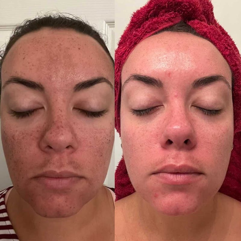 before and after front view of patient after laser treatment