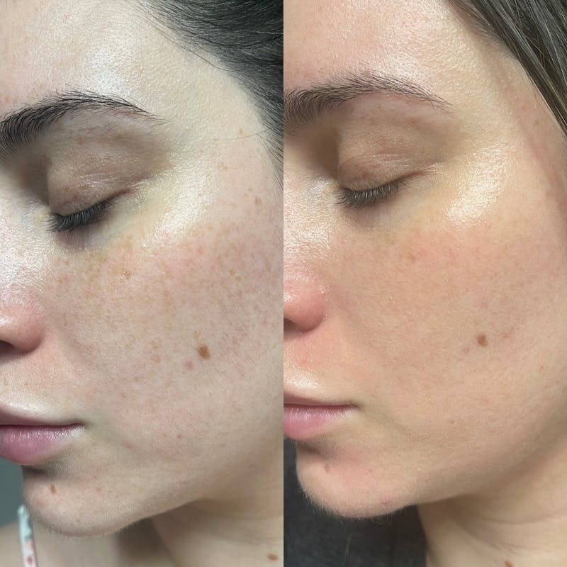 before and after side profile of patient after laser treatment