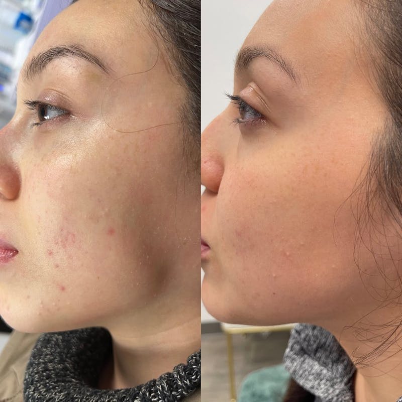 before and after side profile of patient after skin treatment