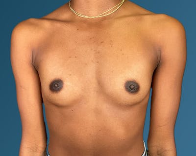 Breast Augmentation Before & After Gallery - Patient 146598386 - Image 1