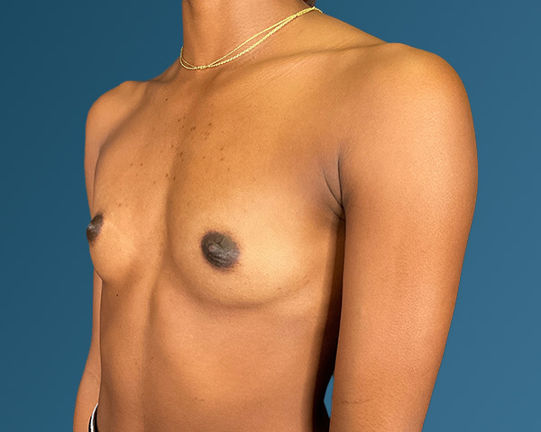 Breast Augmentation Before & After Gallery - Patient 146598386 - Image 7
