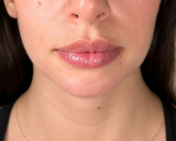 Chin Before & After Gallery - Patient 146598389 - Image 3