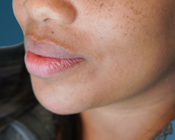 Chin Before & After Gallery - Patient 146598391 - Image 2