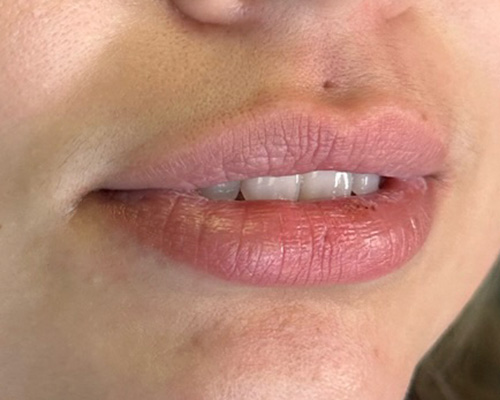 Lip Injection Before & After Gallery - Patient 146598410 - Image 1