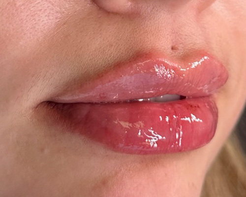 Lip Injection Before & After Gallery - Patient 146598410 - Image 2