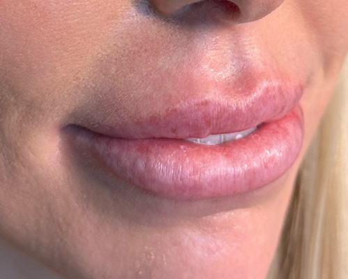 Lip Injection Before & After Gallery - Patient 146598409 - Image 1