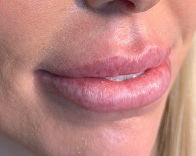 Lip Fillers Before & After Gallery - Patient 146598409 - Image 1