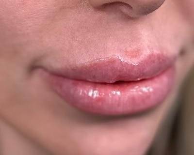 Lip Injection Before & After Gallery - Patient 146598409 - Image 2