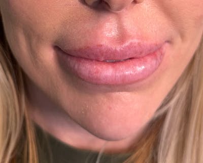 Lip Injection Before & After Gallery - Patient 146598409 - Image 3