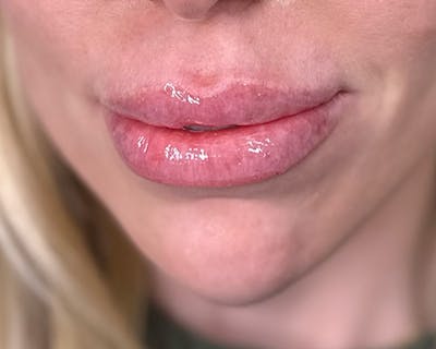 Lip Injection Before & After Gallery - Patient 146598409 - Image 4