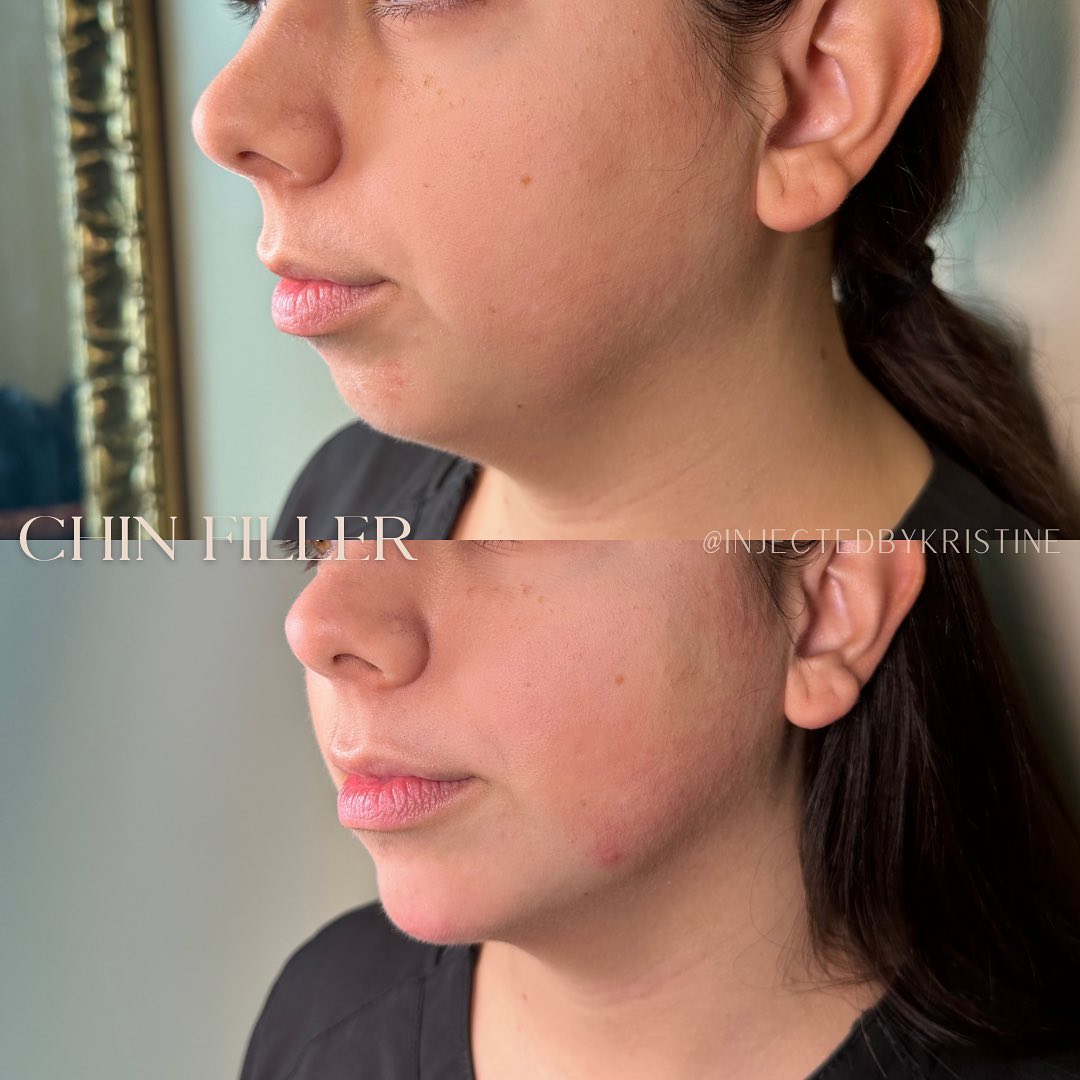 Chin Before & After Gallery - Patient 146598397 - Image 1