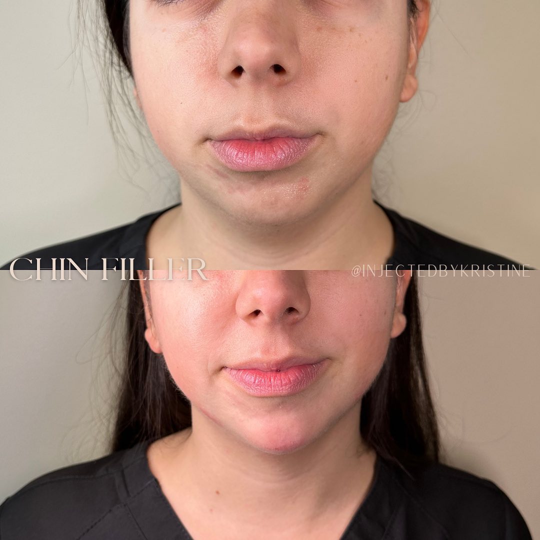 Chin Before & After Gallery - Patient 146598397 - Image 2
