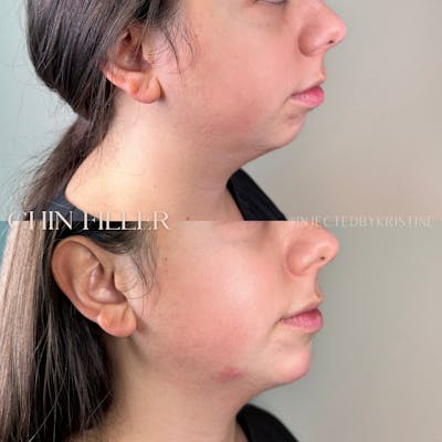 Chin Before & After Gallery - Patient 146598397 - Image 3