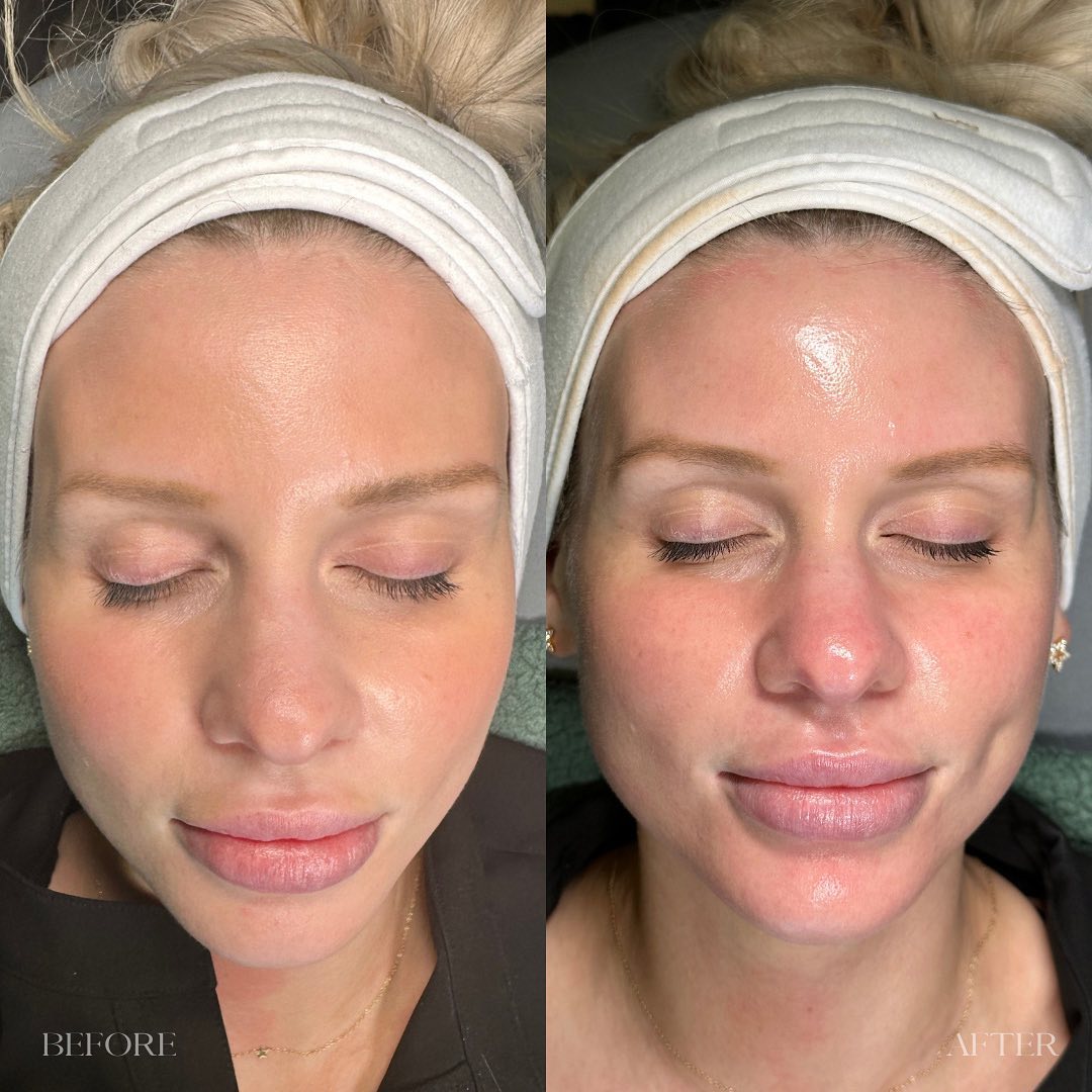 Hydrafacial Before & After Gallery - Patient 146737546 - Image 1